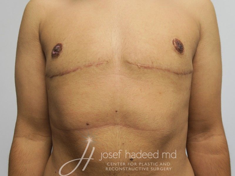 FTM-Top-Surgery--9655 | After FTM Top Surgery