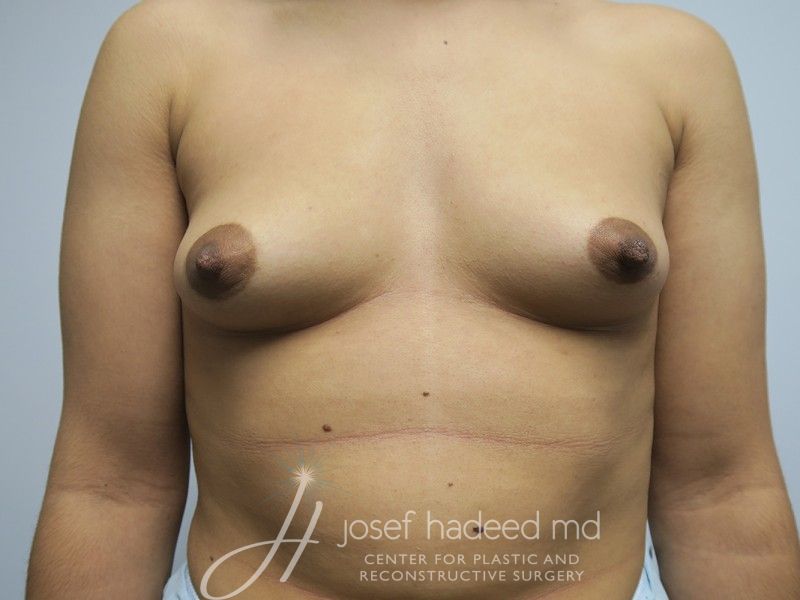 FTM-Top-Surgery--9655 | Before FTM Top Surgery