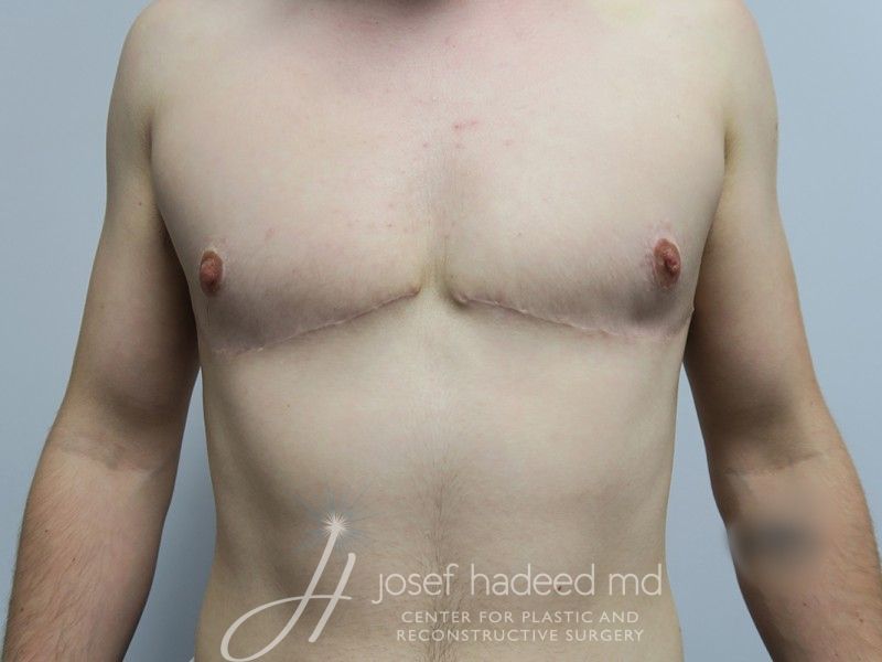 FTM-Top-Surgery--8223 | After FTM Top Surgery