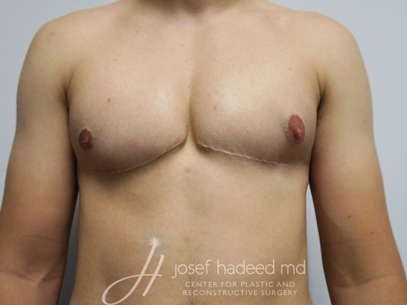 ftm-top-surgery-22-024a-after