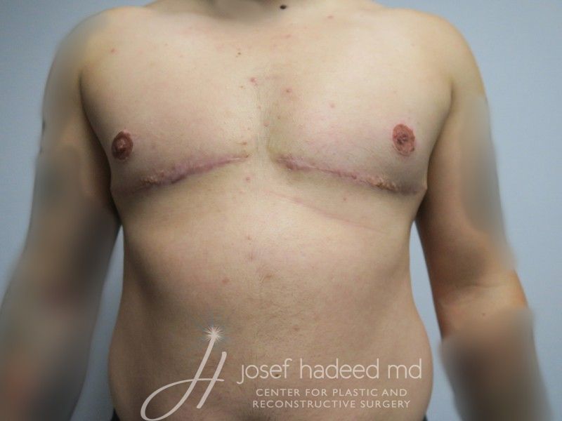 FTM-Top-Surgery--9914 | After FTM Top Surgery