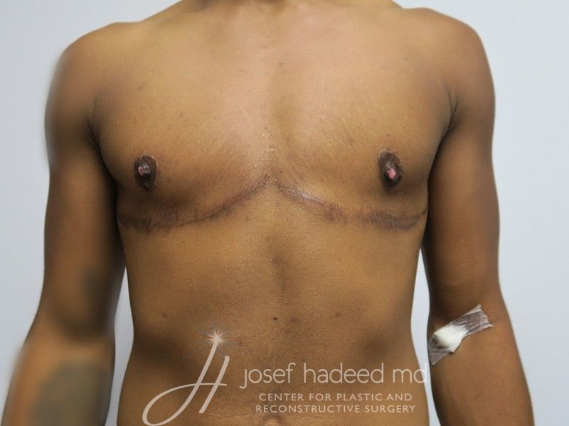 FTM-Top-Surgery-8427 | After FTM Top Surgery