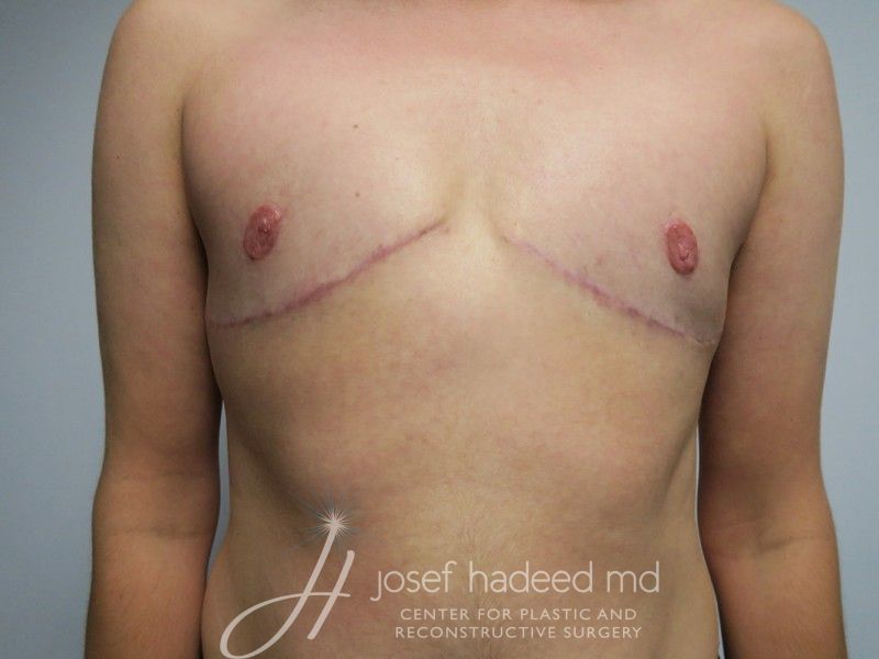 ftm-top-surgery-22-027a-after