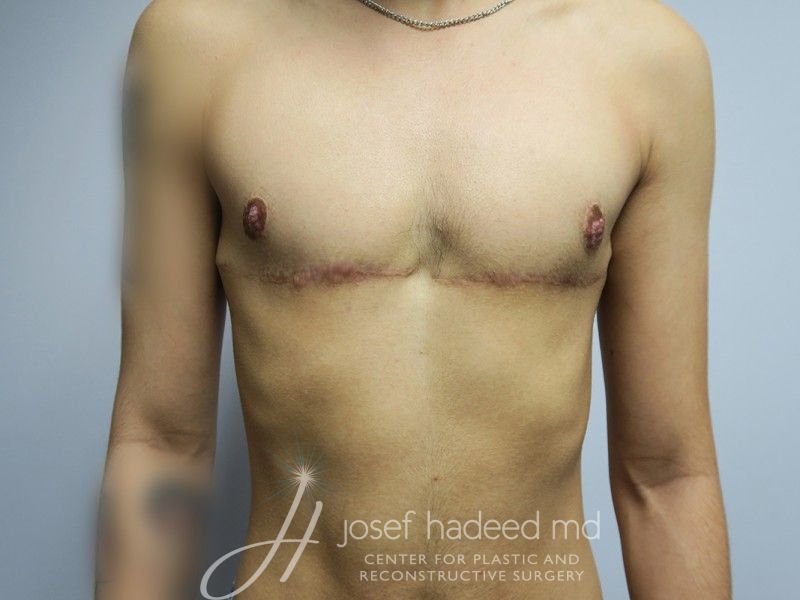 FTM-Top-Surgery--4207 | After FTM Top Surgery