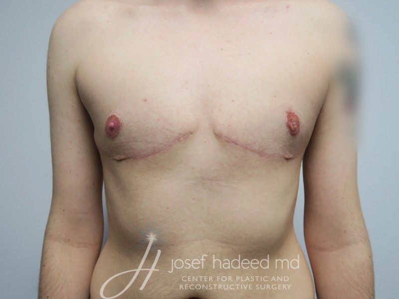 FTM-Top-Surgery--6750 | After FTM Top Surgery