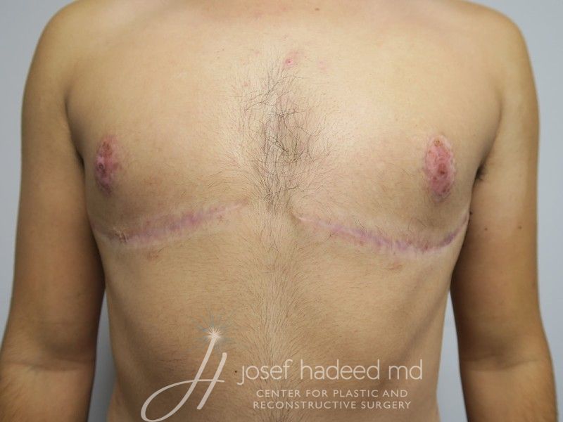 ftm-top-surgery-22-030a-after