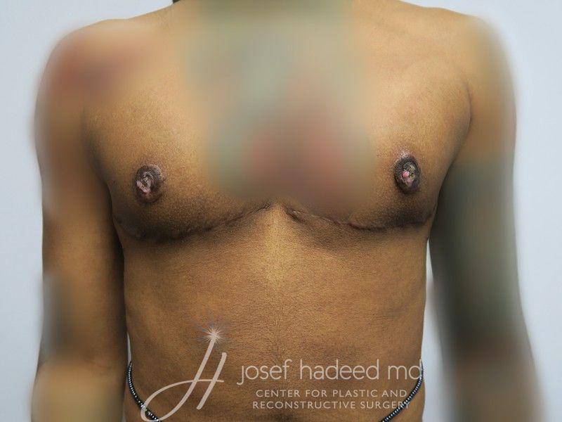 FTM-Top-Surgery--1647 | After FTM Top Surgery