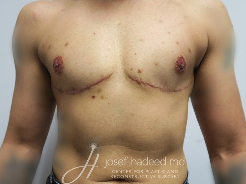 FTM-Top-Surgery--5756 | After FTM Top Surgery