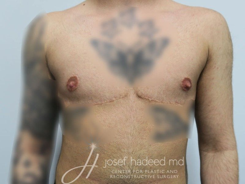 FTM-Top-Surgery-Case--4437 | After FTM Top Surgery