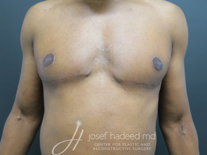 Gynecomastia--5389 | After Gynecomastia Surgery