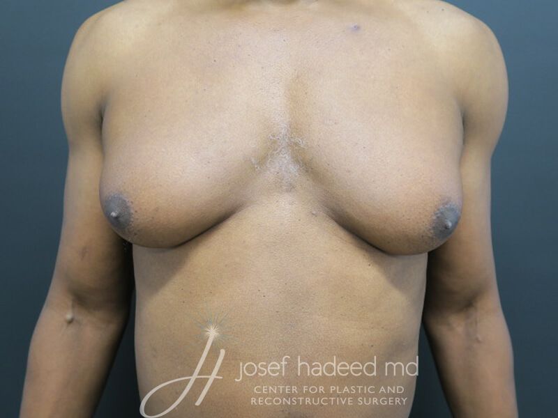 Gynecomastia--5389 | Before Gynecomastia Surgery