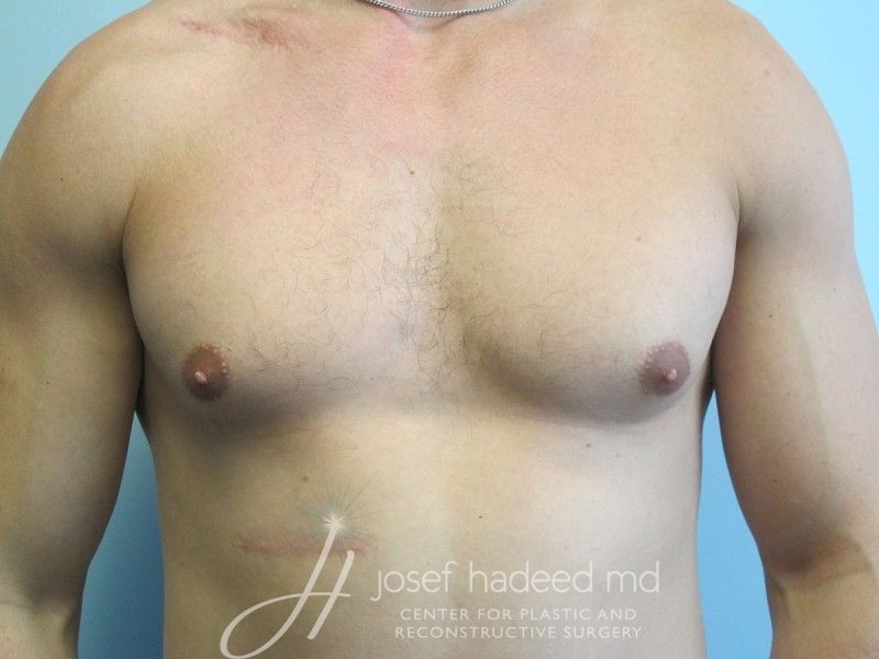 gynecomastia-22-001a-before