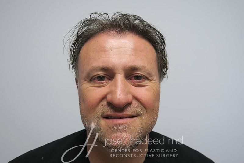 Hair-Transplant--7057 | After Hair Transplant