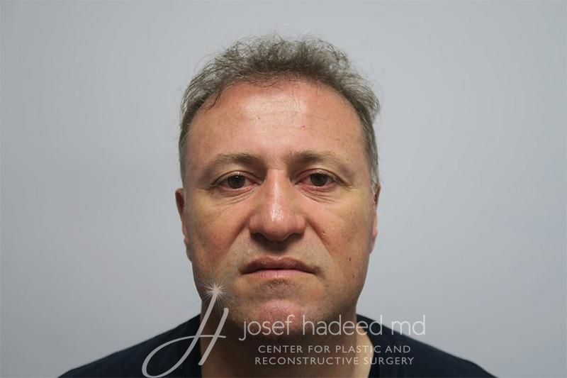 Hair-Transplant--7057 | Before Hair Transplant