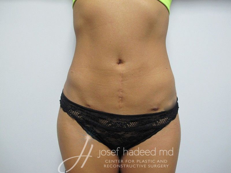 Liposuction--8491 | After Liposuction