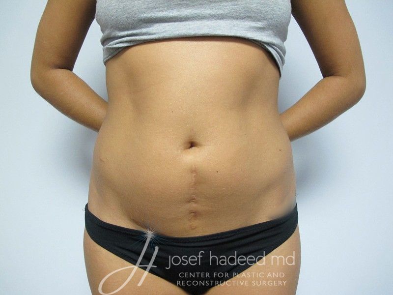 Liposuction--8491 | Before Liposuction