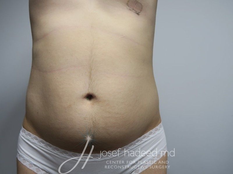 Liposuction--2169 | Before Liposuction