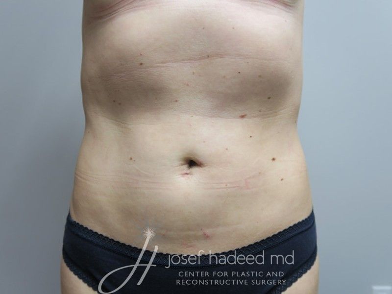 Liposuction--1742 | After Liposuction