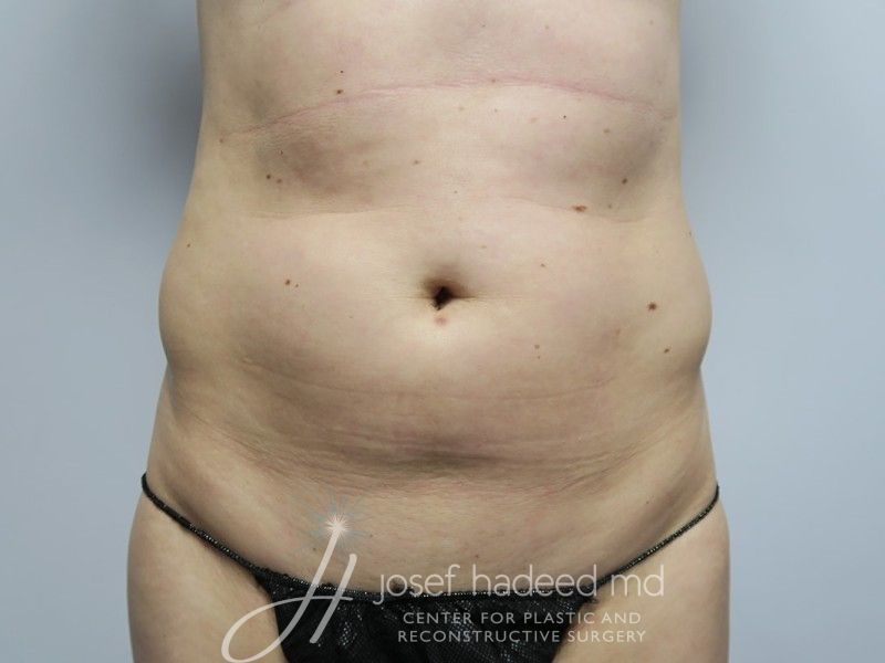 Liposuction--1742 | Before Liposuction