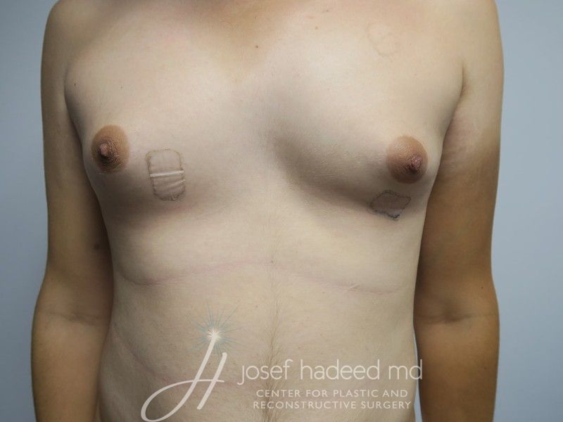 MTF-Breast-Aug--2489 | Before MTF Breast Augmentation