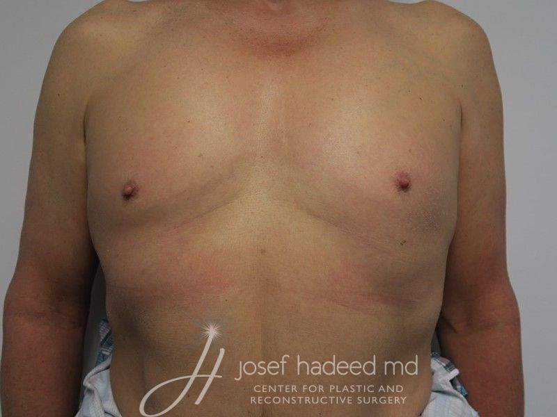 mtf-breast-aug-22-003a-before