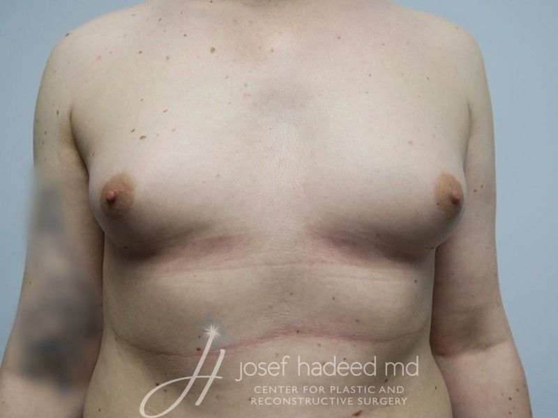 MTF-Breast-Aug--0929 | Before MTF Breast Augmentation