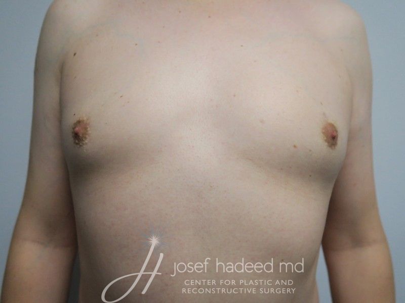 mtf-breast-aug-22-006a-before