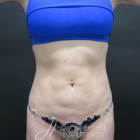 Rib-Remodeling--8326 | Before Rib Remodeling