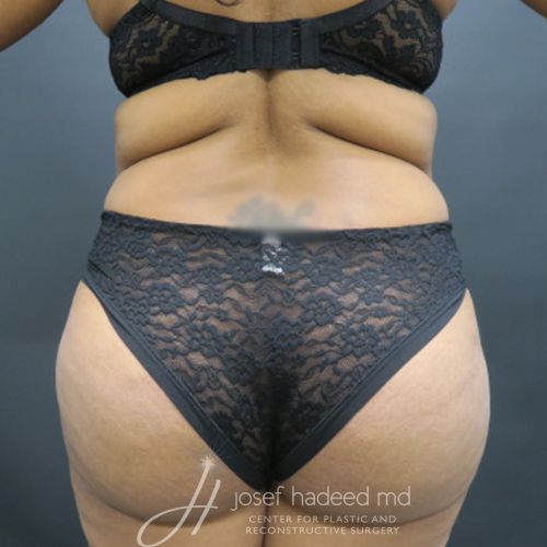 Silicone-Injection-Removal--2382 | Before Silicone Injection Removal